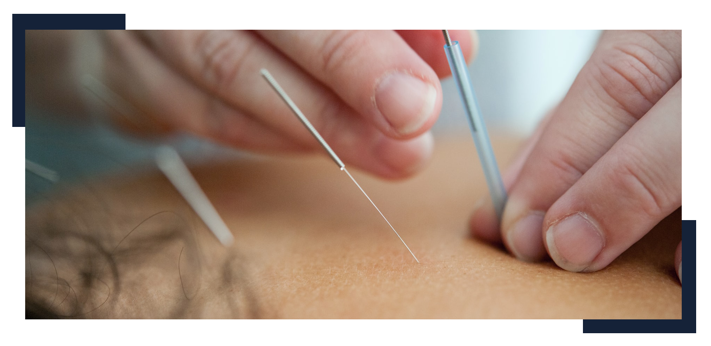 Dry Needling Physical Therapy And Its Benefits Onerehab