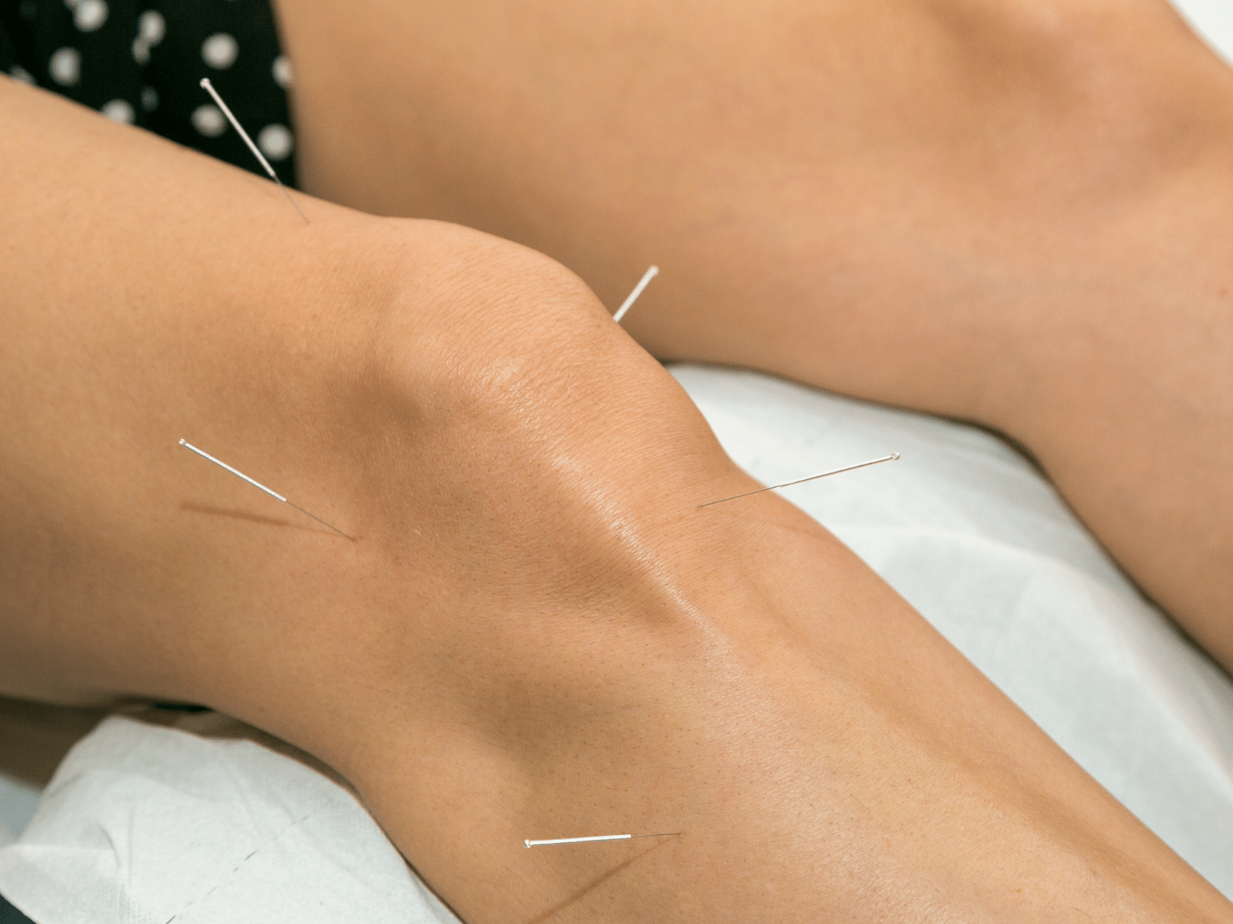 https://onerehab.com/wp-content/uploads/2022/12/dry-needling-therapy-.png